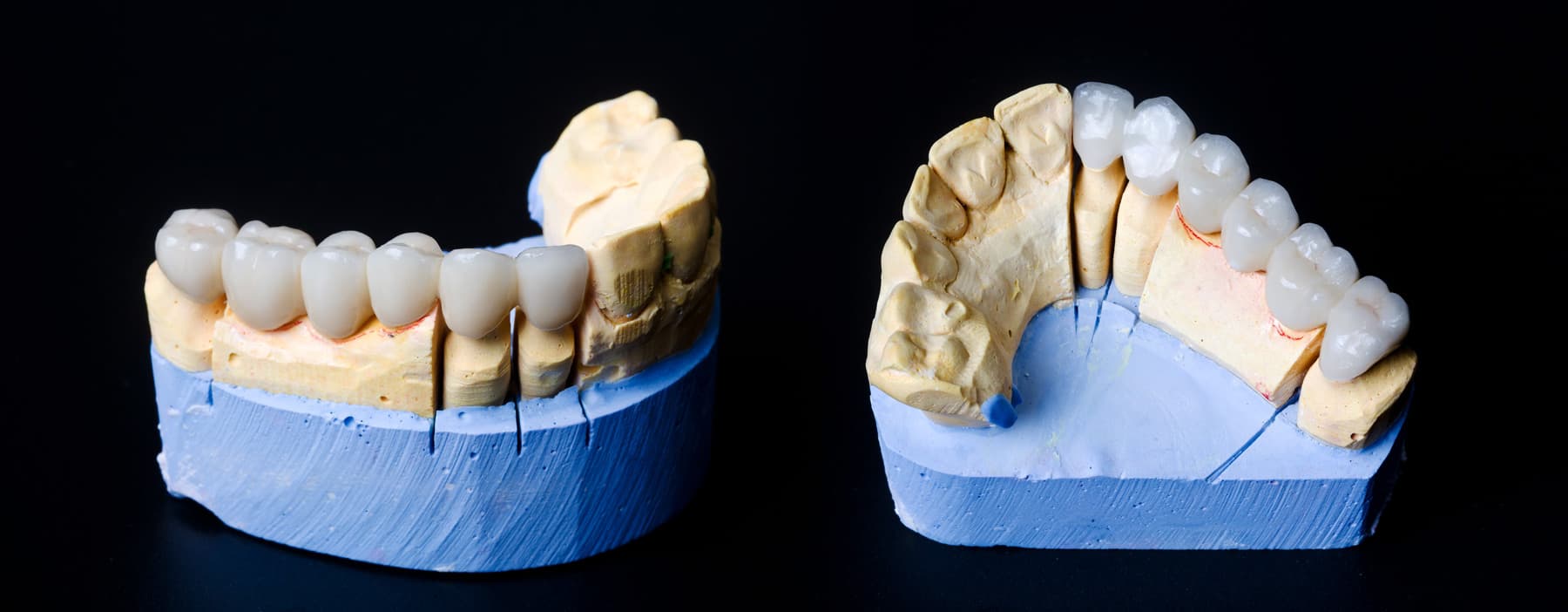 Coronas dentales en Narón